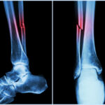 Basics of Calf, Ankle, Foot -- Distance-Learning Course